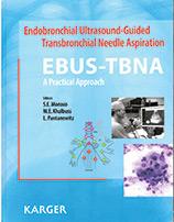 Endobronchial Ultrasound-Guided Transbronchial Needle Aspiration (EBUS-TBNA): A Practical Approach. Sara Monaco.